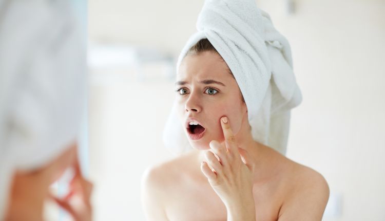 Cera trądzikowa – jakie kosmetyki stosować?